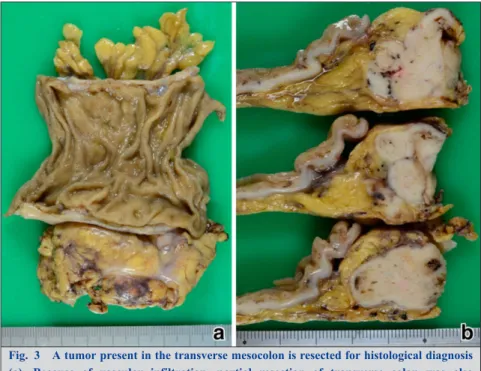 Fig. 3 A tumor present in the transverse mesocolon is resected for histological diagnosis (a)