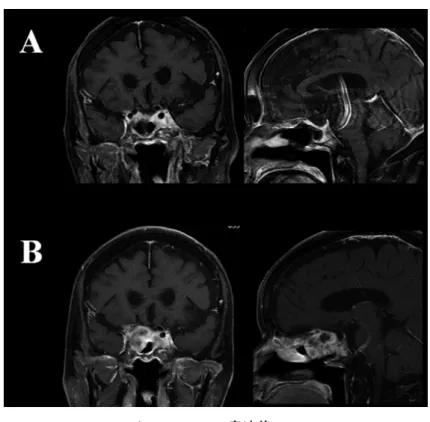 Figure 5.  Cyber-knife 前後の MRI  A.  3 回目の手術施行後の MRI。 