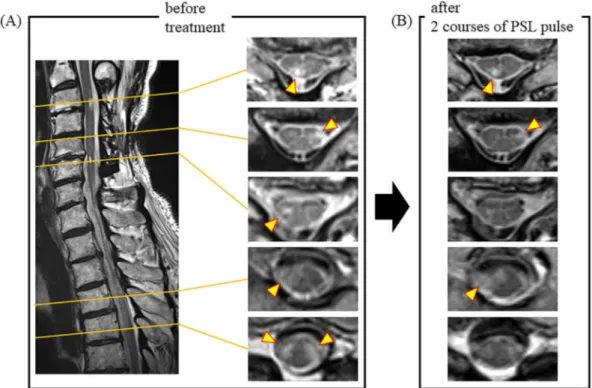 Figure 2. Spinal magnetic resonance imaging findings. (A) Spinal MRI of pretreatment shows ab- ab-normal lesions in both the cervical (C3-6) and thoracic (Th4-5) spinal cords (arrowheads)