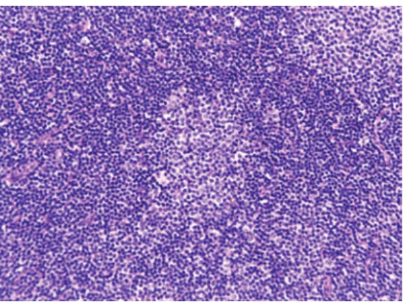 Fig. 1.  Typical features of CLL/SLL. There are two  proliferation centers in this field