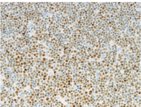 Fig. 5.  LEF1 expression in CLL/SLL. The lymphoma  cells are highly positive for LEF1.