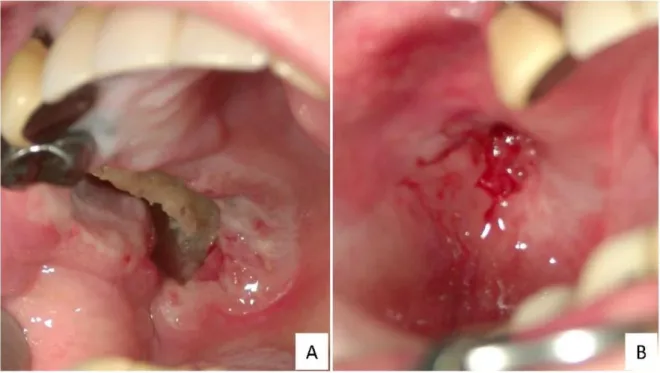 Figure 1. Representative macroscopic findings for EBVMCU in the gingival mucosa. The ulcer developed while the patient was on methotrexate (A)