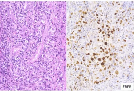 Figure 2. Pathologic findings for polymorphous EBVMCU. A tonsillar EBVMCU in a patient un- un-dergoing methotrexate treatment