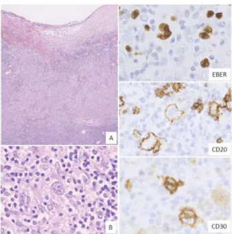 Figure 4. Pathologic findings for classic Hodgkin lymphoma (CHL)-like EBVMCU. A tonsillar EBVMCU in a patient undergoing methotrexate treatment