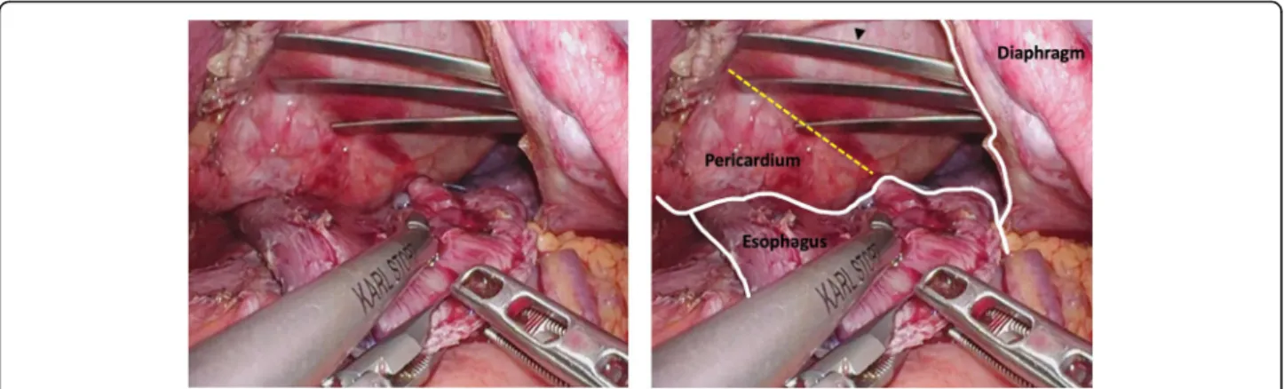 Fig. 2 Intraoperative laparoscopic findings at the beginning of esophagogastric anastomosis