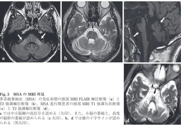 Fig.  3 MSA の MRI 所見