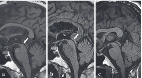 Fig.  4 PSP の MRI 所見