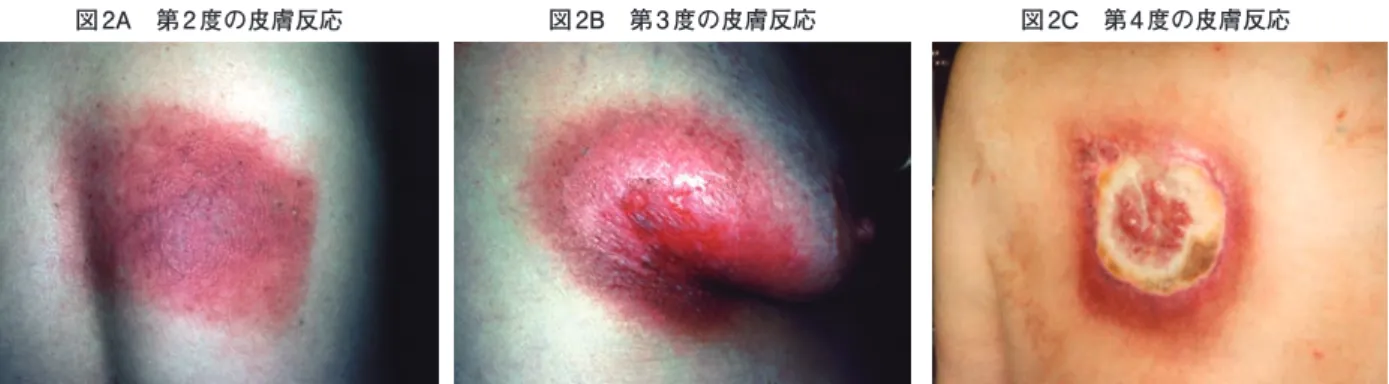 図 2A　第 2 度の皮膚反応 図 2B　第 3 度の皮膚反応 図 2C　第 4 度の皮膚反応