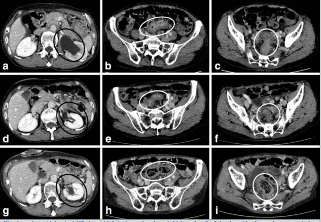 Fig. 1 a, b, c: Abdominal CT showed left hydronephrosis and thickened wall of the sigmoid colon and rectum (circle)