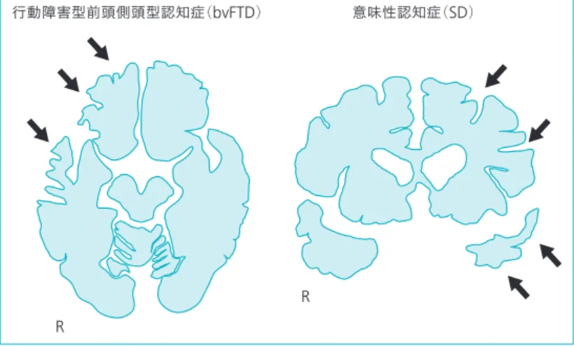 図 1 │ 代表的な MRI 所見（模式図）