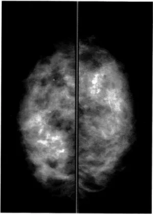 Fig.  1  Mediolateral  mammographic  findings  of  the  bile  breast  showed  neither  tumor  nor   microcal-cifications.
