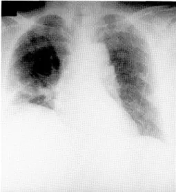 Fig.  5  Chest  X-ray  on  March.  30,  1992.  showing almost  normal  findings.