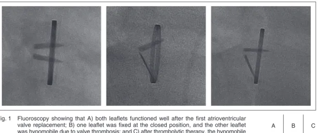 Fig. 1  Fluoroscopy  showing  that  A)  both  leaflets  functioned  well  after  the  first  atrioventricular  valve replacement; B) one leaflet was fixed at the closed position, and the other leaflet  was hypomobile due to valve thrombosis; and C) after t