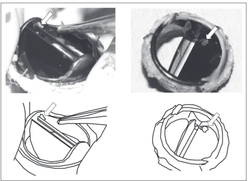 Fig. 4  A white thrombus was macroscopically observed around the hinge of one leaflet (arrows),  and the diagnosis of a white thrombus was confirmed microscopically.