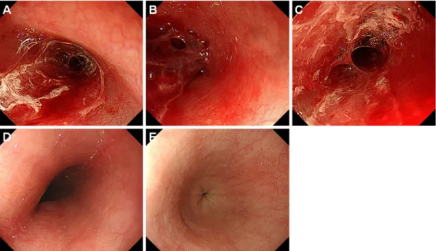 Figure 1. Endoscopic images of case 1. An 18-year-old woman developed desquamative esophagitis  one day after PBSCT (A-C)