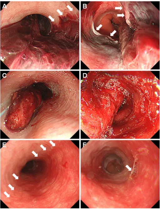 Figure 3. Endoscopic images of case 2. A 29-year-old man who underwent haploidentical PBSCT  developed desquamative esophagitis on day 6 (A, B)