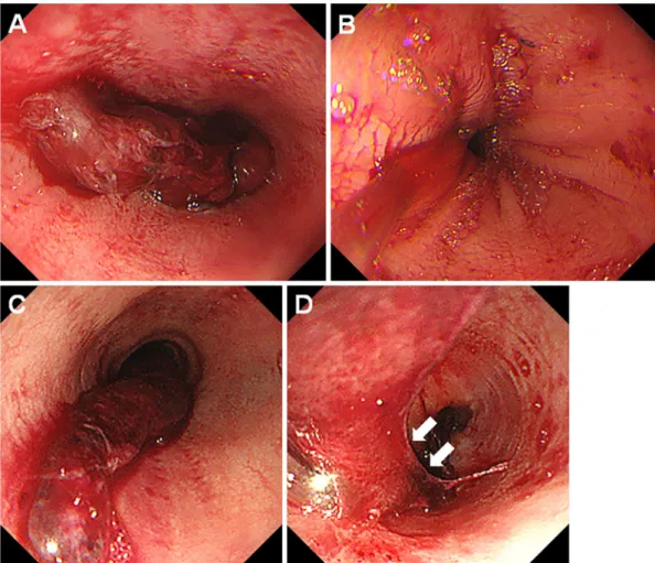 Figure 5. Endoscopic images of case 4. A 16-year-old boy who underwent HLA-1-locus mismatched  PBSCT  developed  desquamative esophagitis on day 5 (A, B)