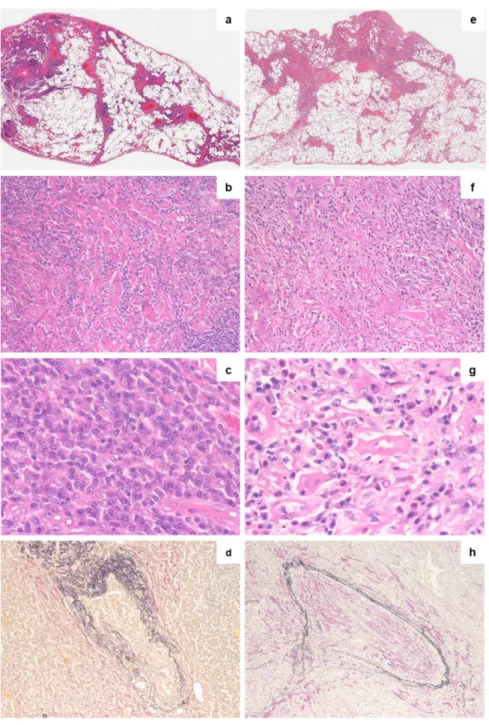 Figure 1. Comparison of histopathological features of lung lesions in PC-iMCD and IgG4-RD