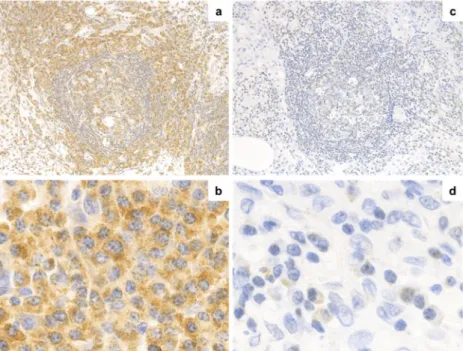Figure 3.  Immunohistochemical analysis of IL-6 expression.  IL-6 expression via  immunohistochemistry in PC-iMCD (a, 200× and b, 400×) and IgG4-RD (c, 200× and d, 400×) groups  is shown