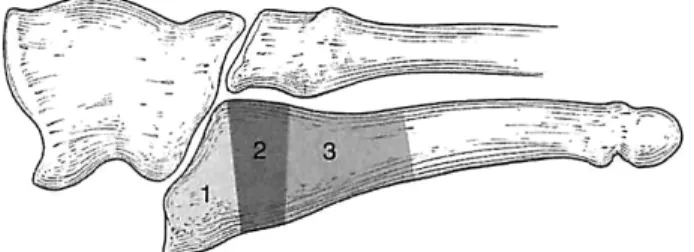 Fig. 1　 Zone  1,   Avulsion  fracture  of  tuberosity  [1]; Zone  2,   Jones  fracture  in  the  metaphyseal-diaphyseal  junction; Zone  3,   Diaphyseal stress fracture.