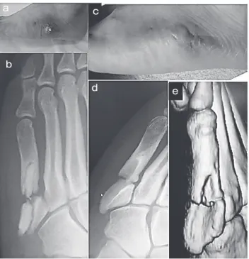 Fig. 4　 photograph of left foot (a),  A-P (a) and oblique (b) of  foot X-ray,  The bone graft became exposed; photograph of left foot  (c) oblique (d) of X-ray and CT of foot (e),  The bone graft had to  be removed 5 years postoperatively.