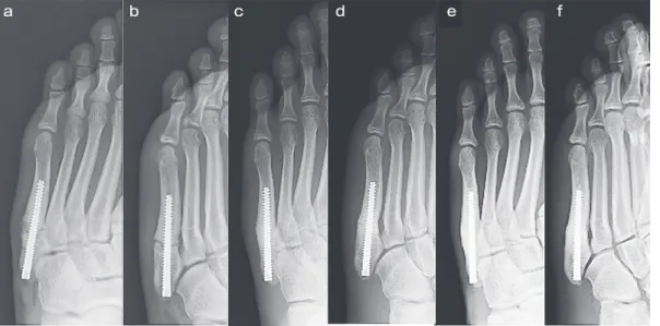 Fig. 8　 A-P (a) and oblique (b) of foot X-ray,  The broken screw was removed 1 month after re-injury,  and intramedullary screw re-ﬁxation  was performed with an Acutrak 4/5; A-P (c) and oblique (d) foot X-ray images,  The patient achieved bone union at 5 