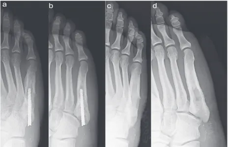 Fig. 10　 (Case 4) A-P (d) and oblique (e) foot X-ray images,  Loosening around the screw was observed; A-P (c) and oblique (d) foot  X-ray images,  The screw was removed 1 year and 1 month postoperatively.