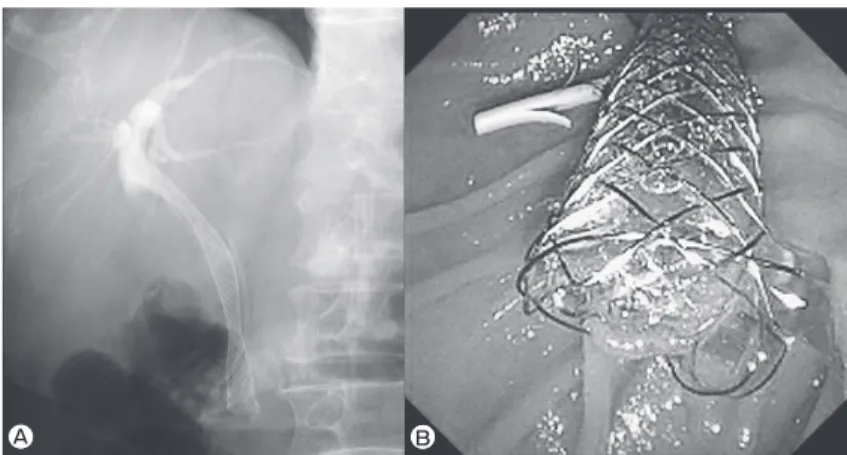 Fig. 2　 Placement of pancreatic stent and fully covered metal stent.  A,  Fluoroscopic imaging; B,  Endoscopic imaging.