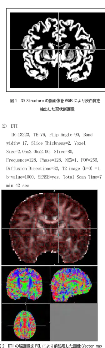図 2  DTI の脳画像を FSL により前処理した画像(Vector map と Color map)  2)  平成 26 年 12 月末までに患者群 7 名の検査を終了した。HAND 診断では検査の標準値の平均から 1SDあるいは2SD以上の低下の有無を評価するが、本邦では年齢や教育年数に応じた標準値が公表されている検査が少ない。そのため、本研究では健常群と患者群との比較で診断を行う予定である。 しかし、現時点ではまだ健常群の検査は行っていない。本報告においては、本邦で使用可能な“参考値”をもとに検