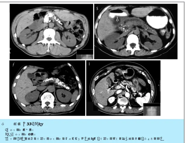 図 1 腹部 X 線 CT 像 a：びまん性混合結石 b，c：びまん性小結石 d：造影 CT．主膵管の不規則なびまん性の拡張とともに，膵辺縁が不規則な凹凸を示す膵の変形が認められる．abcd