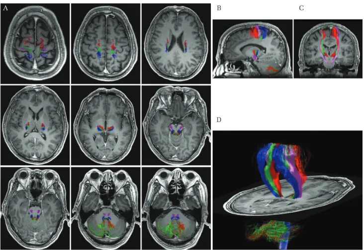 Fig. 2  Preoperative diffusion tensor imaging-based fiber tractography (DTI-FT). Consecutive axial (A), sagittal  (B), coronal (C), and 3D (D) images of representative DTI-FT achieved preoperatively are shown.