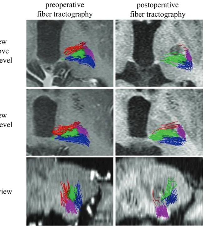 Fig. 4  Pre/postoperative DTI-FT after thalamotomy. This figure is pre- and postoperative DTI-FT of the repre- repre-sentative case after thalamotomy