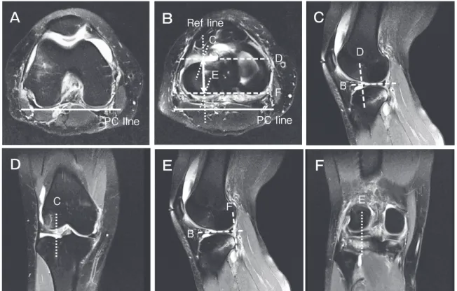Fig. 2　 MRI-based  measurements  of  the  lateral  meniscus.   A  coronal image of an ACL-reconstructed knee (the right knee).