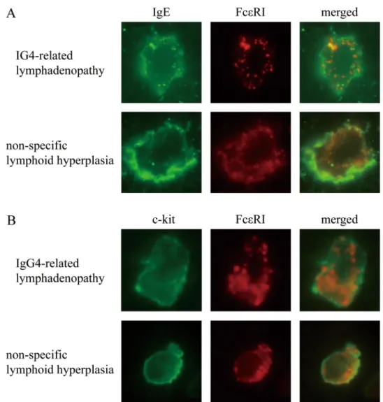 Figure 4.  Dual immunofluorescence of mast cells in immunoglobulin G4-related lymphadenopathy and non- non-specific lymphoid hyperplasia