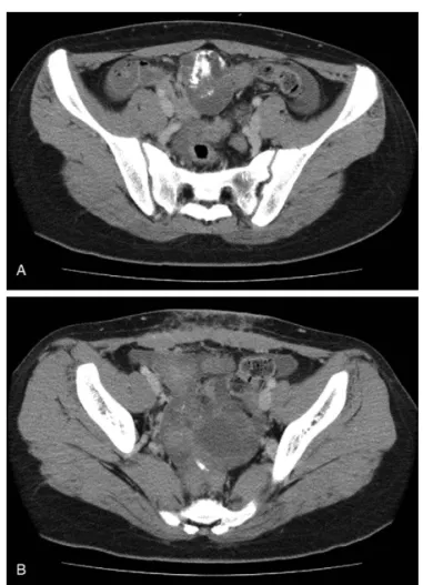 Figure 2. Post-chemotherapy ﬁ ndings from abdominal computed tomogra- tomogra-phy (A) and positron emission tomogratomogra-phy – computed tomography (B)