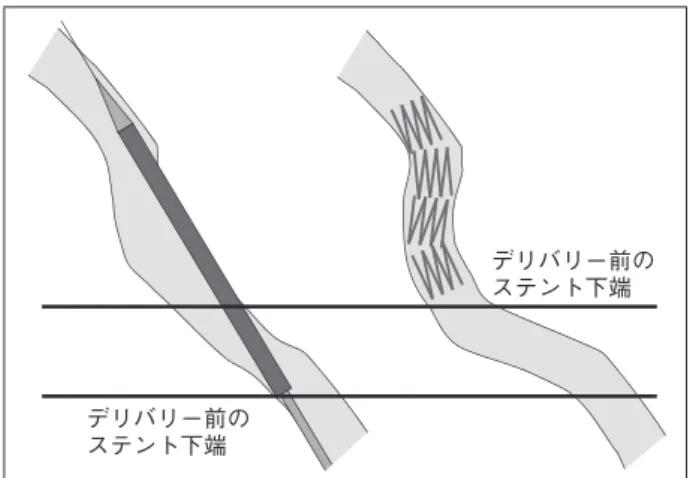 図 7  Self-expanding stent の recoil に対する対処