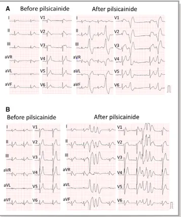 Figure 3. Pilsicainide-induced polymorphic ventricular tachycar- tachycar-dia and ventricular ﬁbrillation