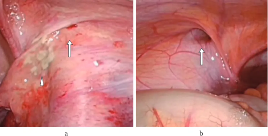 Fig. 2　Laparoscopic findings show a slightly enlarged right inner inguinal ring for 