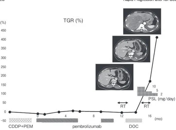 Fig. 2　 Computed tomography showing rapid tumor growth after initiation of steroid.