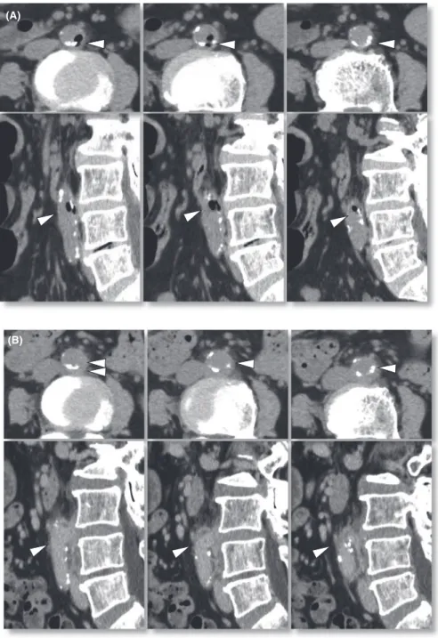 FIGURE 1  Abdominal computed  tomography on admission (A) and on day  11 (B). Air-density spots were found in  the aortic wall (A, arrowheads)
