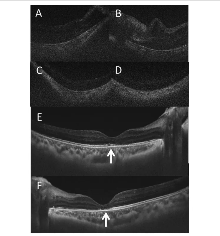 Figure 2.  Optical coherence tomography. At the age of 5 years of 11 months (A, right eye; B, left eye), 1 month before the start of  adalimumab
