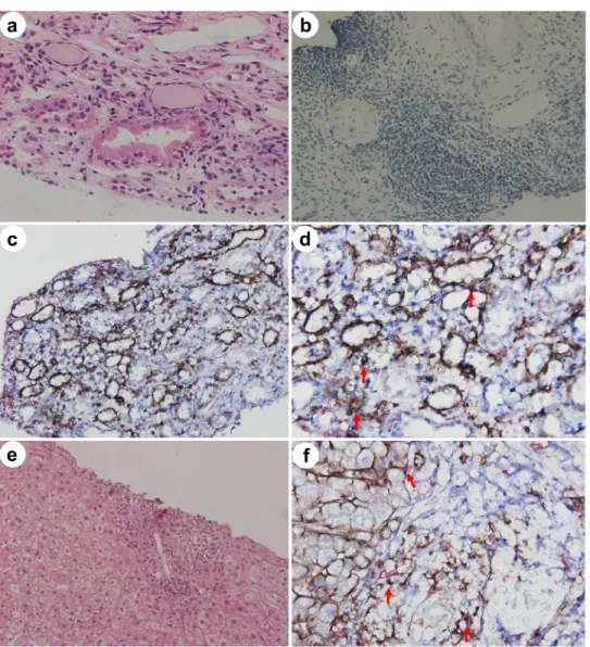 Figure 1. The second renal biopsy and liver biopsy ﬁ ndings in case 1. (a) Light microscopy image with periodic acid  Schiff stain, showing massive in ﬂ ammatory cell in ﬁ ltration in renal tubulointerstitium