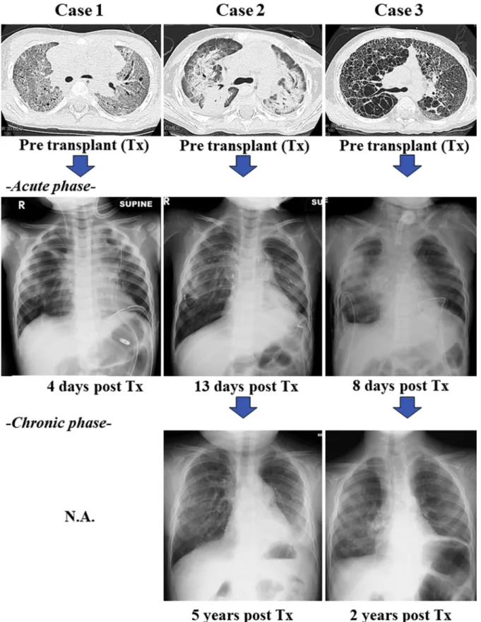 FIGURE 1. Acute and chronic phases of computed tomography scan and chest X-ray. Tx, Transplant; N.A., not applicable.