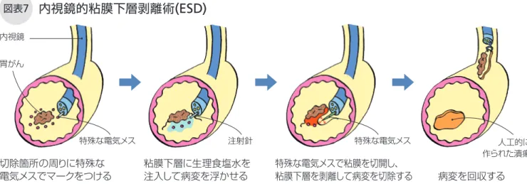 図表 7 内視鏡的粘膜下層剥離術 (ESD) 腹部超音波検査を追加します。ヘリコバクタ ー・ピロリ菌が陽性のときは除菌治療を行い、経過観察します。除菌後に新たながん（二次がん）が発生するおそれもあるため、内視鏡検査は定期的に受けたいものです。一方、がんを完全に切除できていない、またはリンパ節転移の可能性があると判定された場合は、原則的に追加外科切除が必要になります。この手術を行う際は病変の部位や患者の年齢、併存疾患などを考慮することも大事なので、担当医とよく相談してください。体への負担が少なく、胃の機能も維
