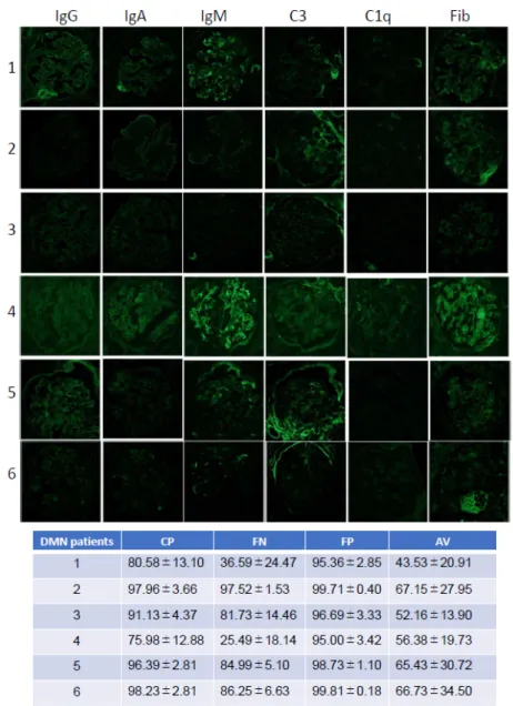 Figure 3. Test DN images and each program diagnosis. Patient number; 1, 2, 3, 4, 5, 6  Immunofluorescent imaging type; IgG, IgA, IgM, C3, C1q, Fibrinogen (Fib)
