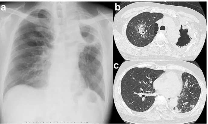 Fig. 3 Representative diagnostic images of chronic pulmonary aspergillosis in both lungs 
