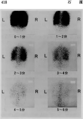 Fig.  2b  換 気 シ ンチ:  5分 後 に 集 積 を認 め, 6分 後 に は消 失 して お り換 気 シンチ ス コア は3と 判 定 1991年3月 に 精 査 加 療 の 目 的 で 当科 へ 入 院 と な っ た