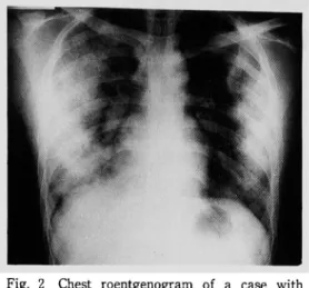 Fig.  2  Chest  roentgenogram  of  a  case  with   drug-induced  PIE  syndrom  shows  diffuse   bilateral,  predominantly  peripheral,   patchy  infiltration  shadows.