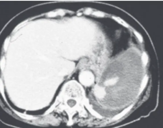 Figure 4　A 24-year-old female of delayed splenic rupture