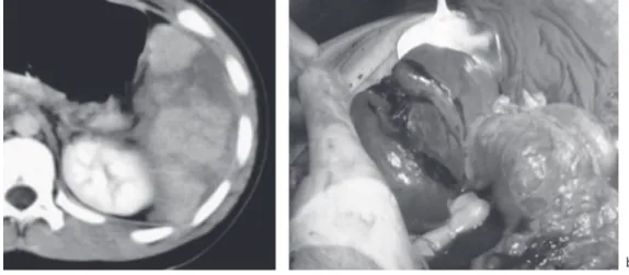 Figure 6　 Flowchart of 64 patients with splenic trauma experienced between 2003 and 2015